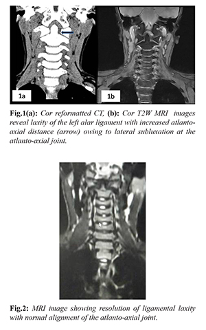 Grisels Syndrome A Rare Non Traumatic Subluxation Of Atlanto Axial Joint